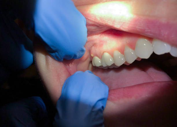 Best Emergency Dental Services for Seniors in Cheraw, SC